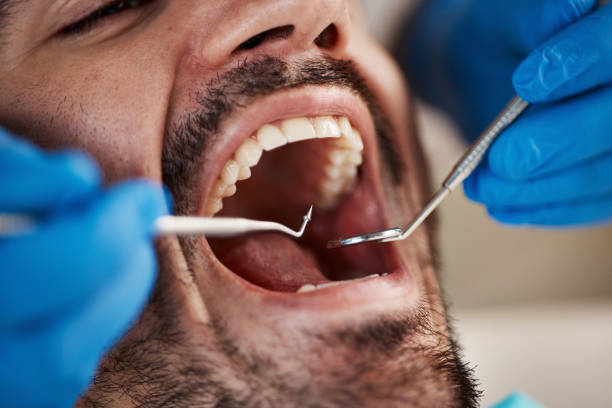Best Emergency Dentist for Lost Fillings or Crowns in Pontiac, IL